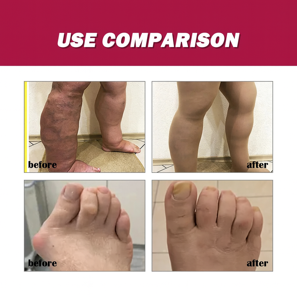 Crème contre la polyarthrose rhumatoïde