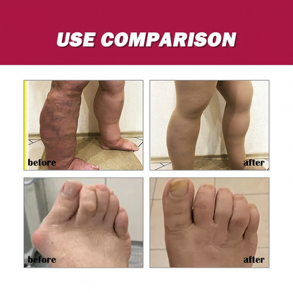 Crème contre la polyarthrose rhumatoïde
